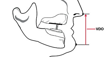 CE: Simplified Accurate Denture Records