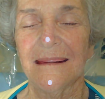 CE: Simplified Accurate Denture Records