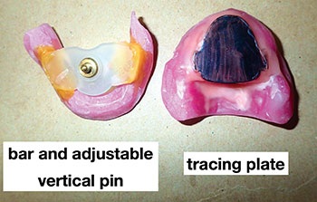 CE: Simplified Accurate Denture Records