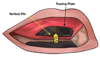 CE: Simplified Accurate Denture Records