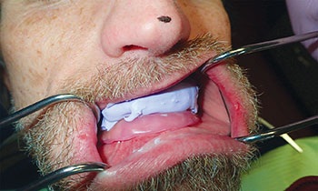CE: Simplified Accurate Denture Records