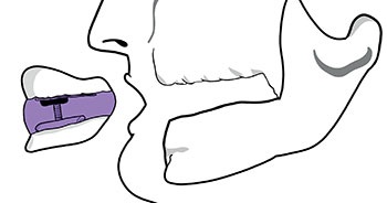 CE: Simplified Accurate Denture Records