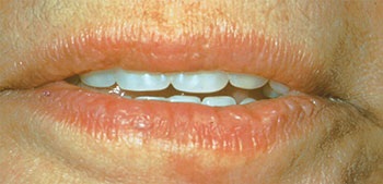CE: Simplified Accurate Denture Records