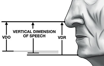 CE: Simplified Accurate Denture Records