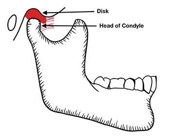 CE: Simplified Accurate Denture Records
