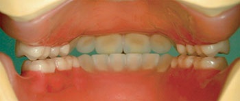 CE: Simplified Accurate Denture Records