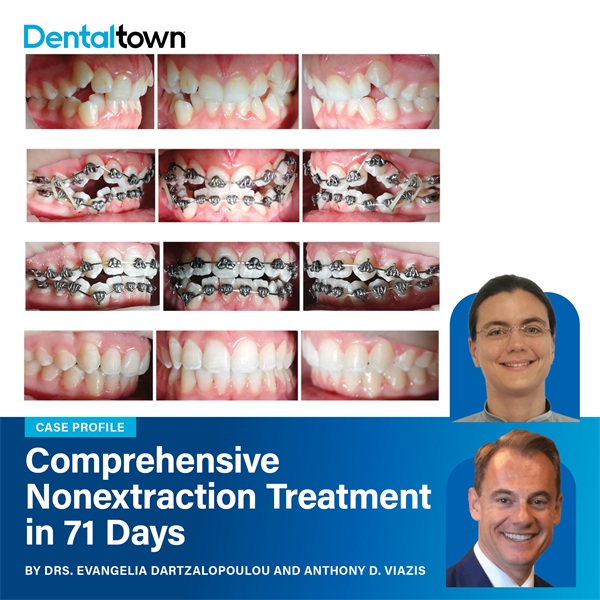 Case Profile: Fastbraces