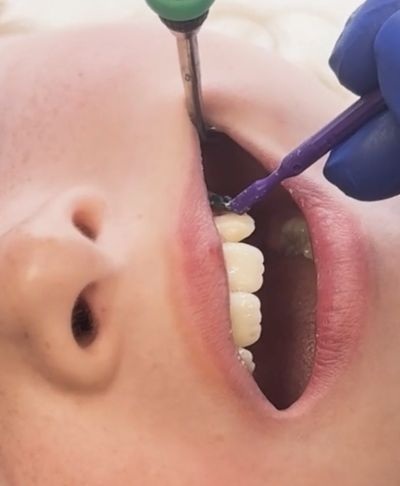 What We Know About Fluoride-Releasing Varnish