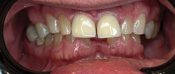 Fully Digital and Guided Full-Arch Dentistry