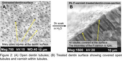 What We Know About Fluoride-Releasing Varnish