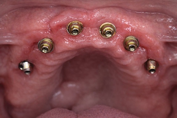 Fully Digital and Guided Full-Arch Dentistry