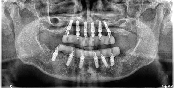 Fully Digital and Guided Full-Arch Dentistry