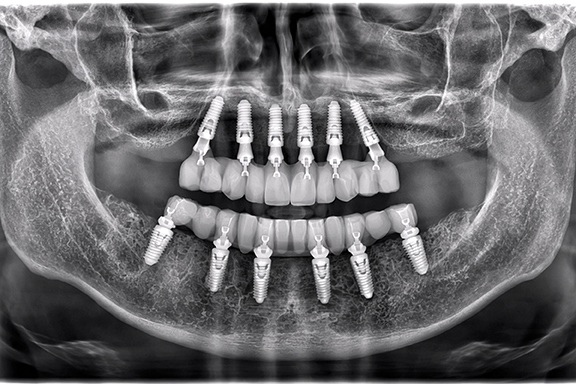 Fully Digital and Guided Full-Arch Dentistry