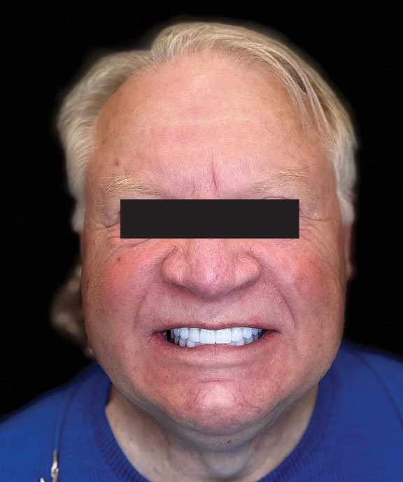 Fully Digital and Guided Full-Arch Dentistry
