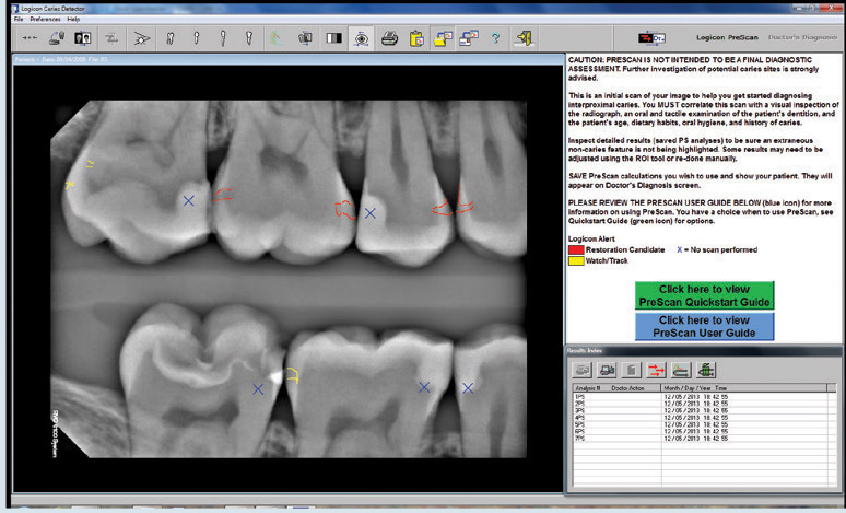 Logicon Caries Detector Software