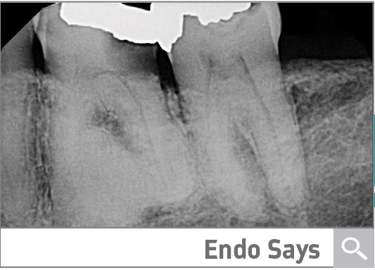 Case Presentation: Immediate Implant