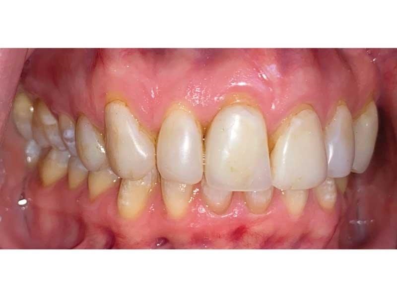 Dental Occlusion