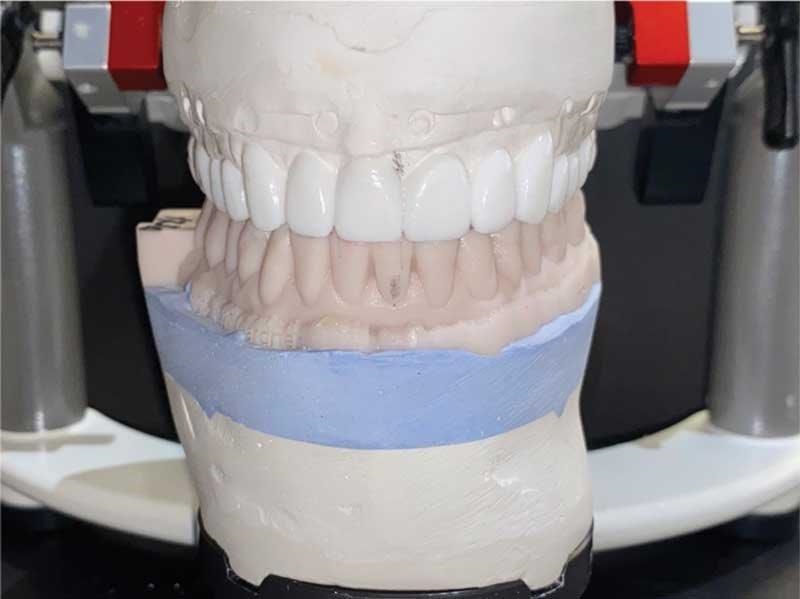 Dental Occlusion