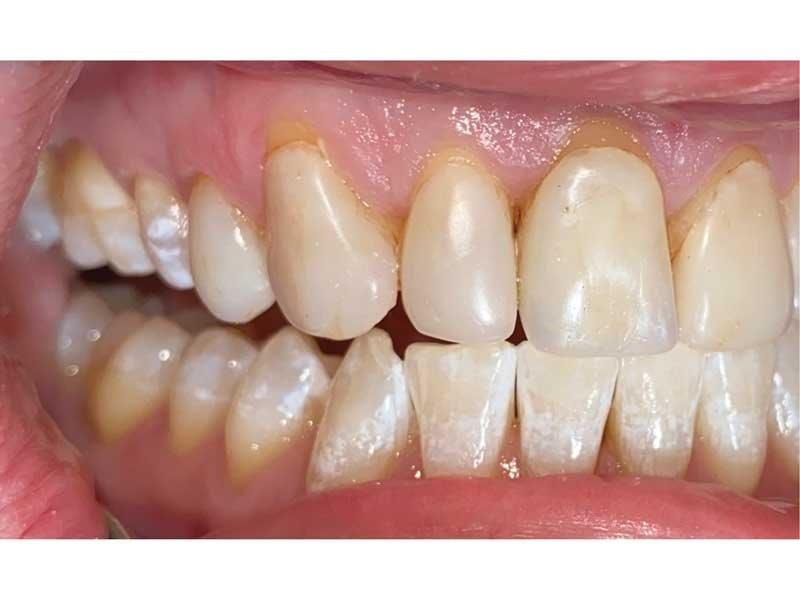 Dental Occlusion