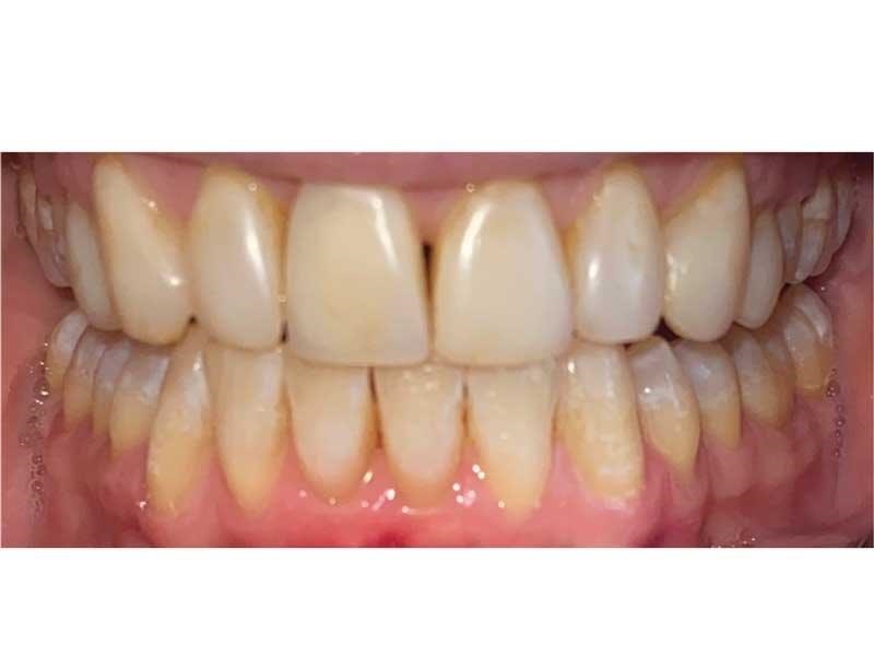 Dental Occlusion
