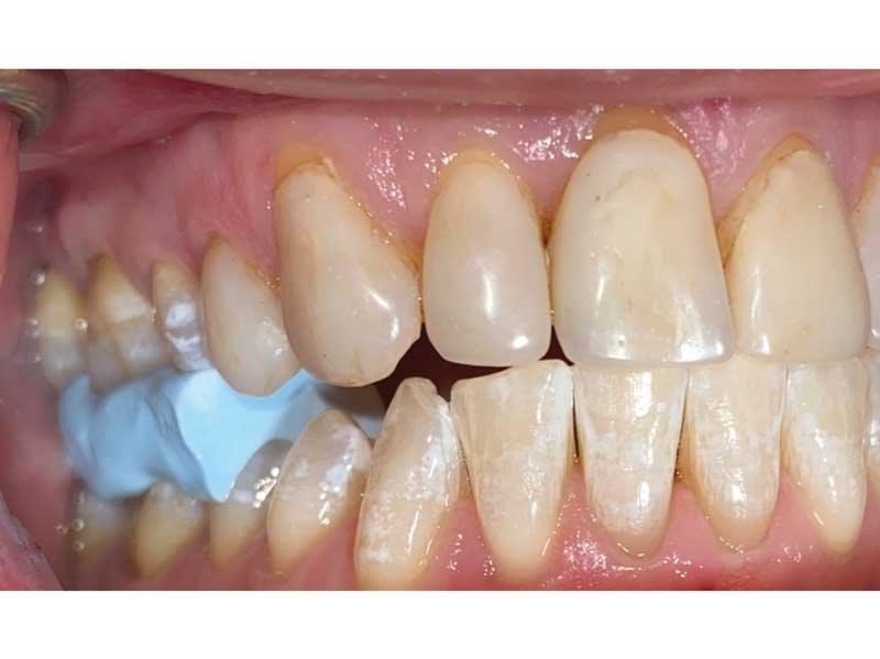 Dental Occlusion