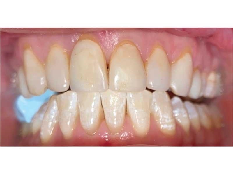 Dental Occlusion