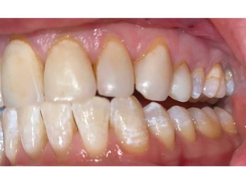 Dental Occlusion
