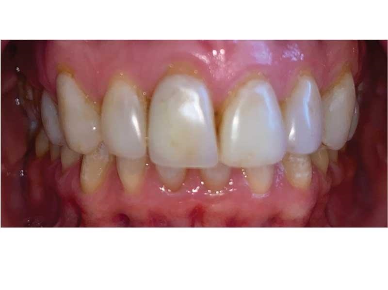 Dental Occlusion