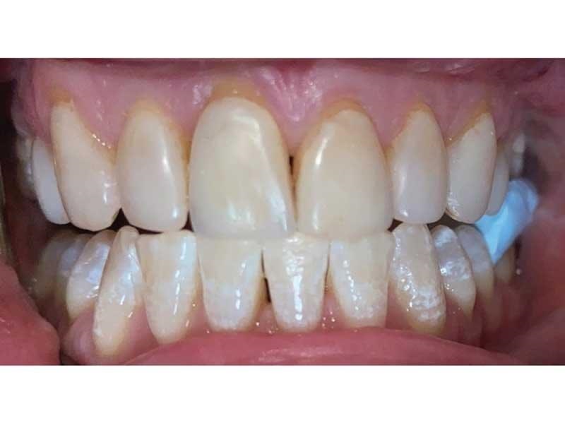 Dental Occlusion