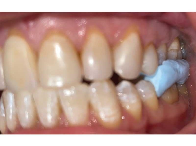 Dental Occlusion