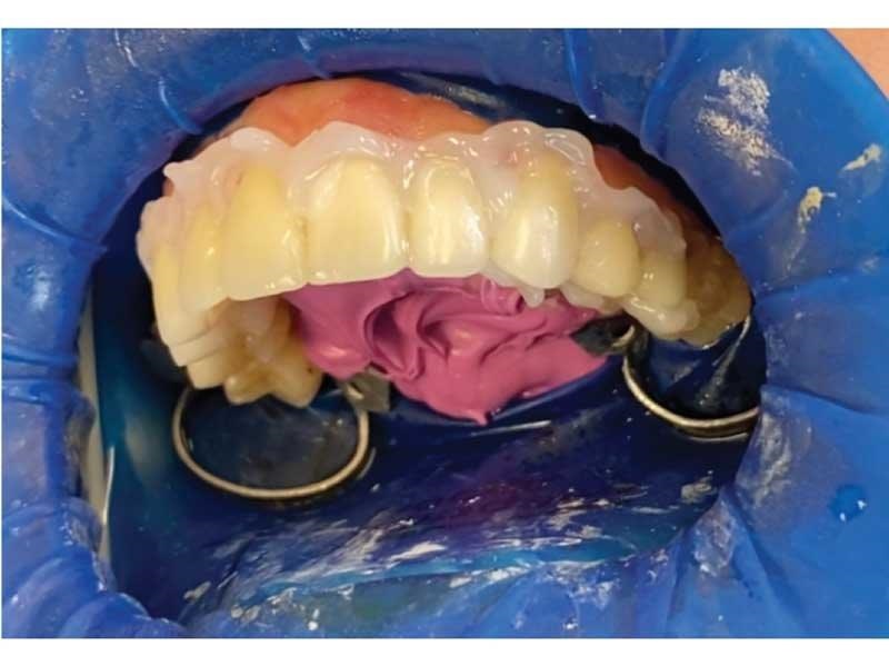 Dental Occlusion