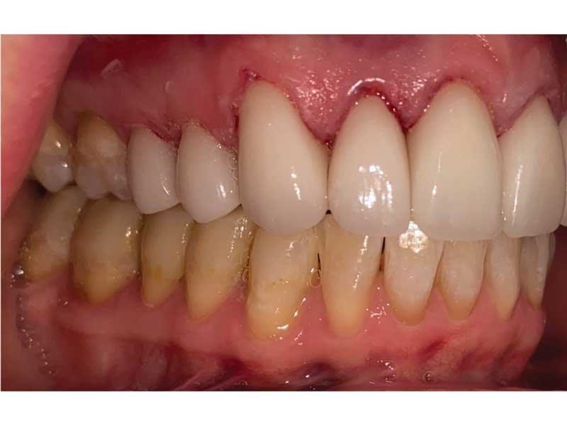 Dental Occlusion