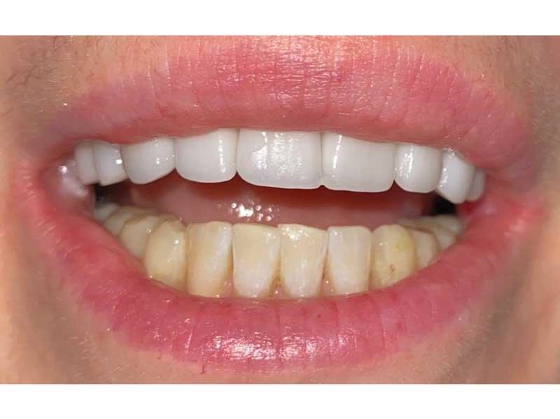 Dental Occlusion
