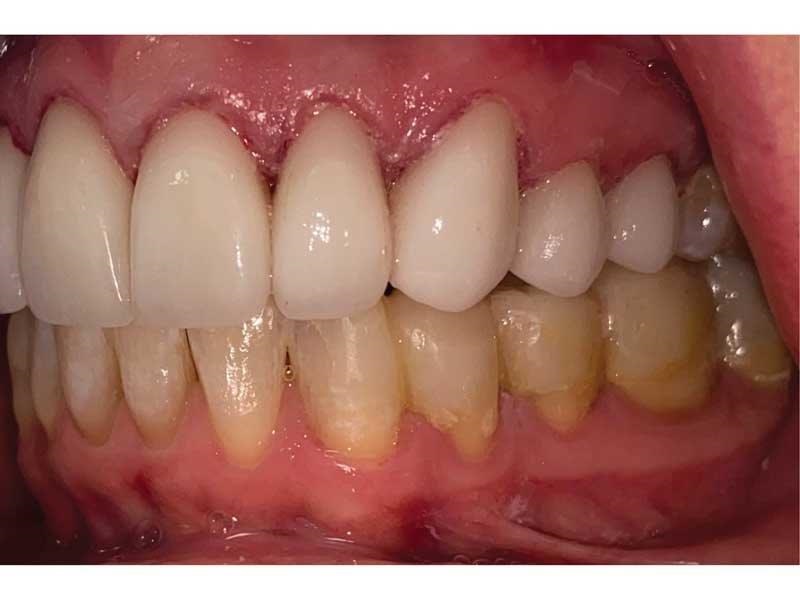 Dental Occlusion