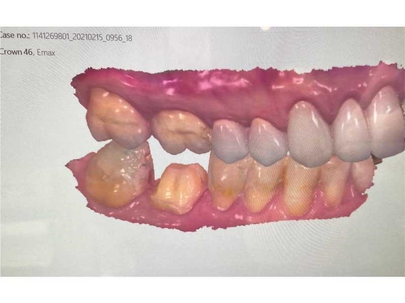 Dental Occlusion