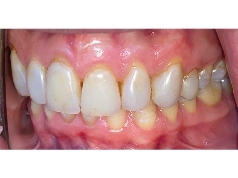 Dental Occlusion