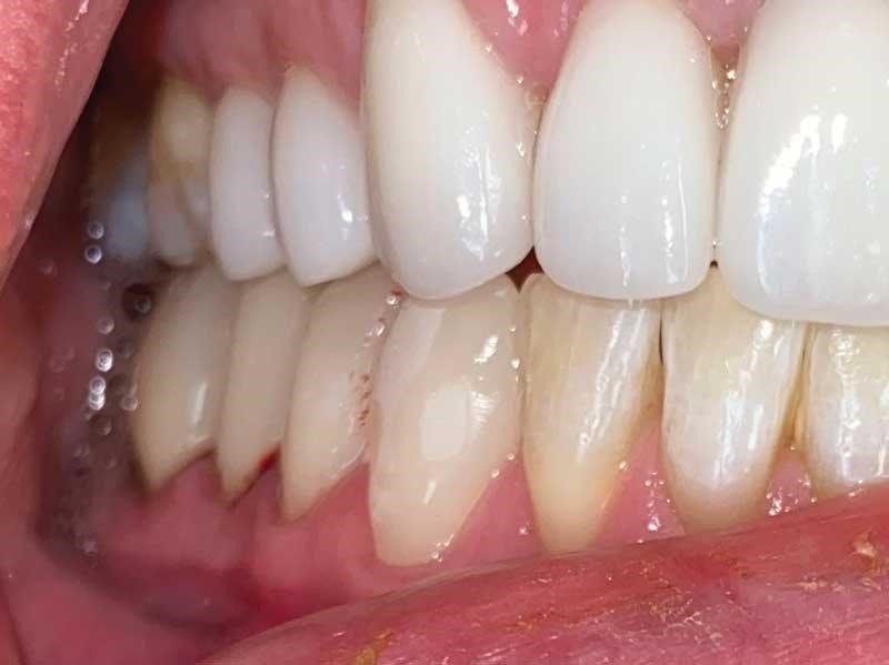 Dental Occlusion