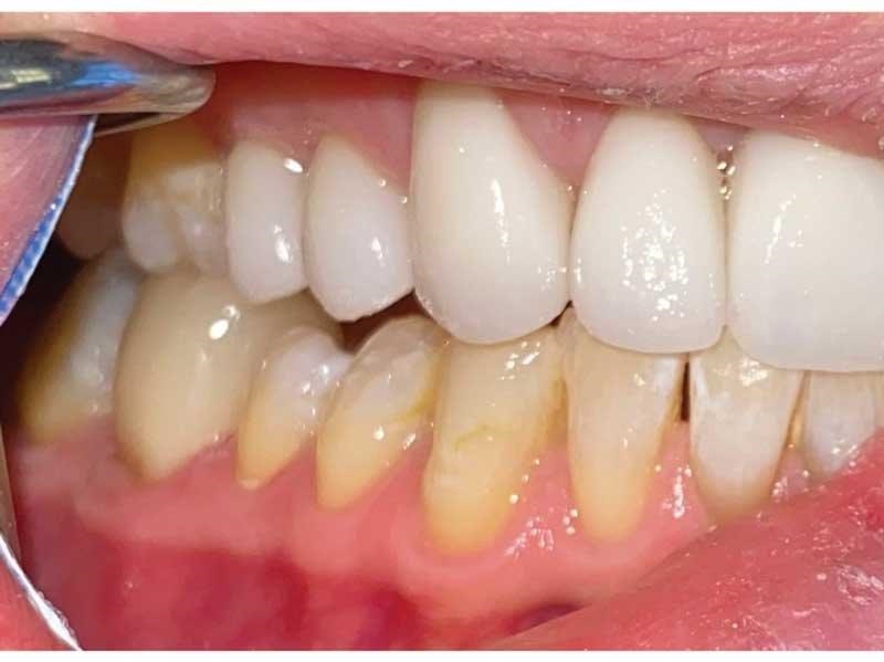 Dental Occlusion