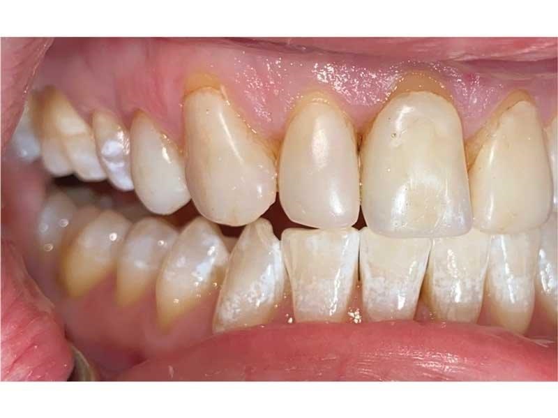 Dental Occlusion