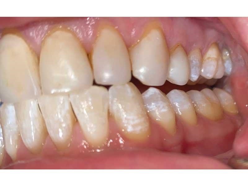 Dental Occlusion