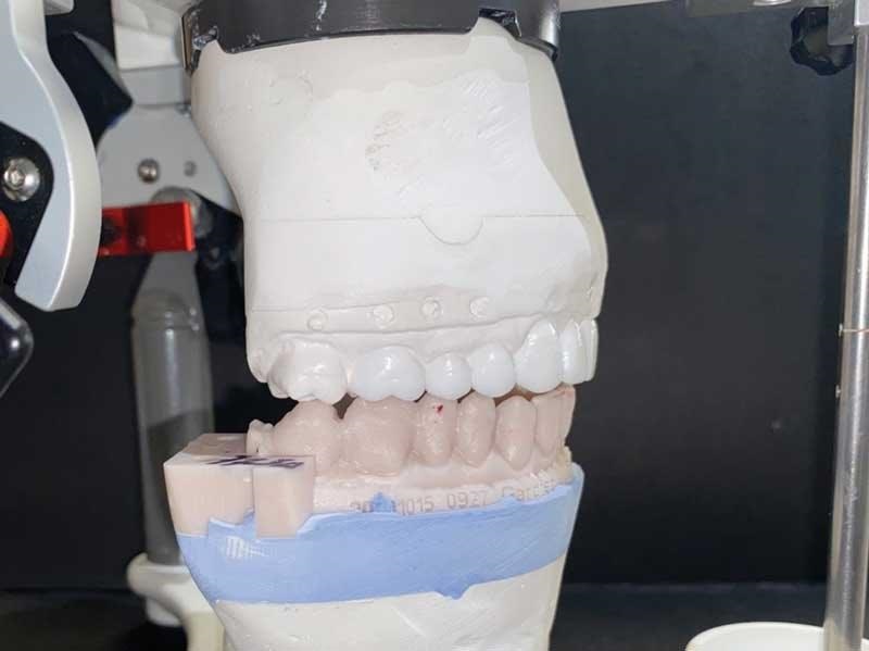 Dental Occlusion