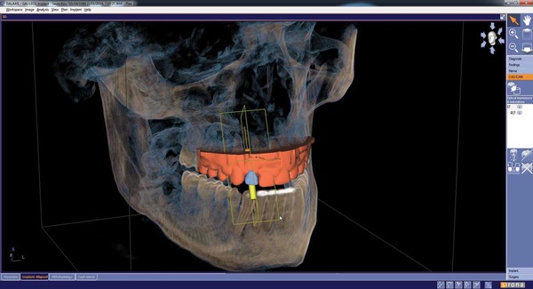 The Digital Age: Dental Implant Technology