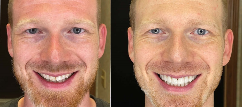 Less Is More: Highly Aesthetic, Minimally Invasive Veneers