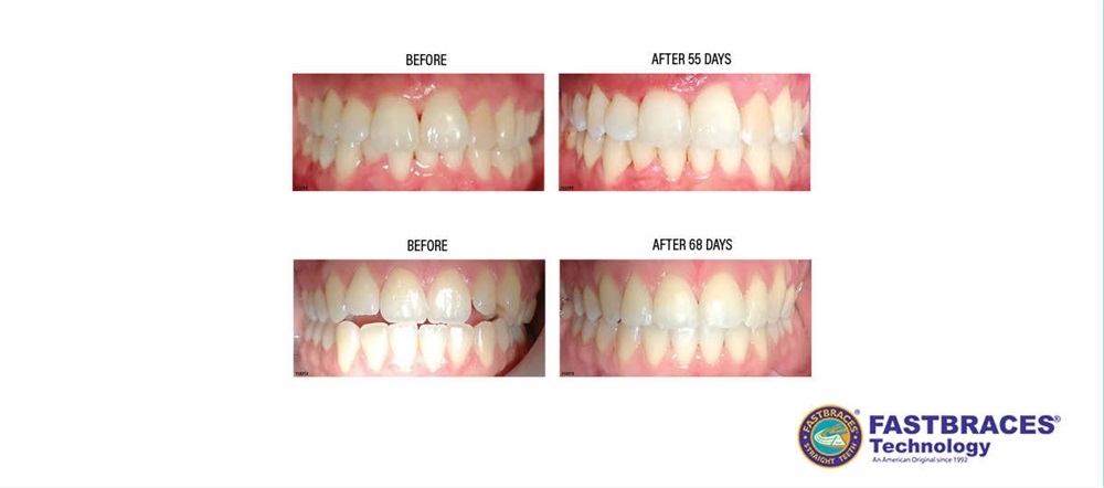 Product Profile: Fastbraces