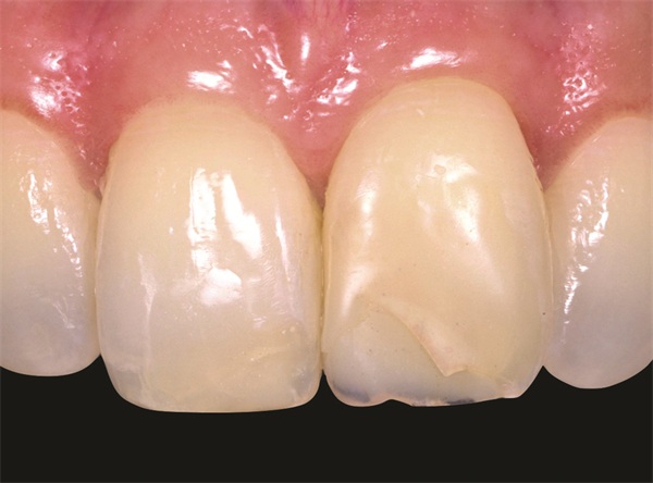 Clinical Profile: Confident Smiles with Natural-looking Restorations