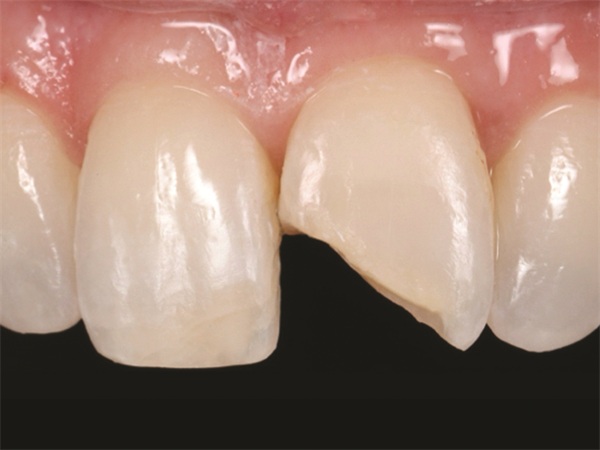 Clinical Profile: Confident Smiles with Natural-looking Restorations
