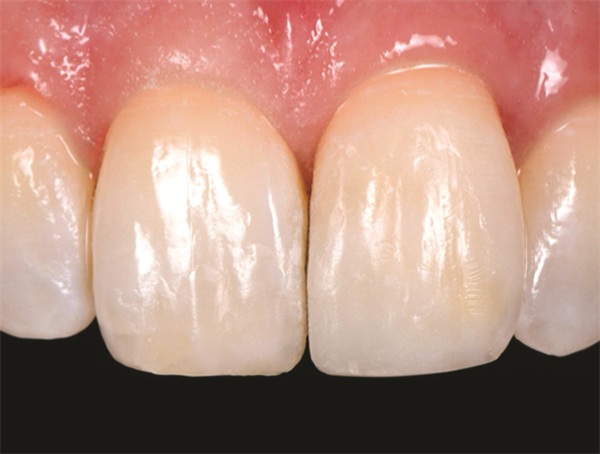Clinical Profile: Confident Smiles with Natural-looking Restorations