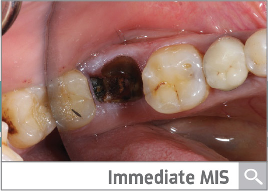 Case Presentation: Immediate Implant