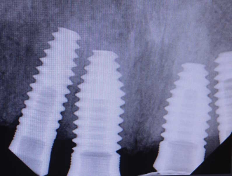 Dental Implant Abutment Screws_A New Twist