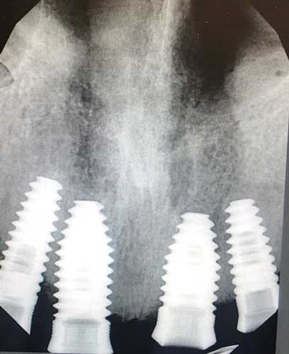 Dental Implant Abutment Screws_A New Twist